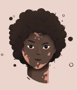 Portrait of woman with curly hair and vitiligo by Samy Löwe