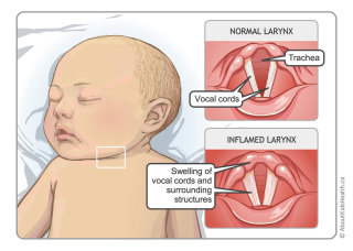 bébé atteint d&#39;une condition de croup, illustration par Shelley Li Wen Chen