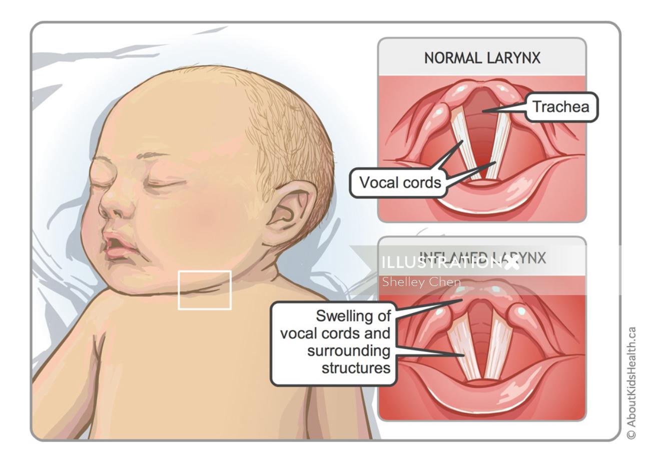 bébé avec illustration de la condition du croup par Shelley Li Wen Chen