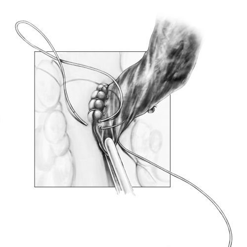 Coronary Artery Bypass Surgery procedure illustration by Shelley Li Wen Chen