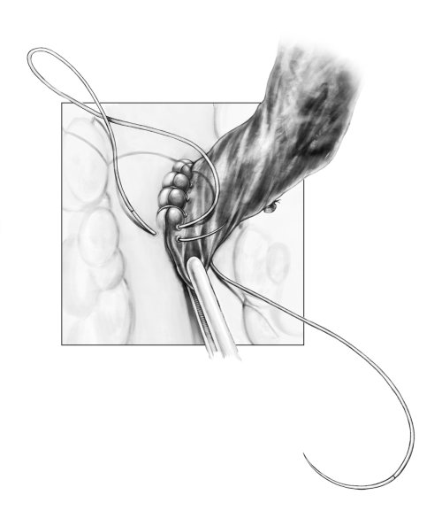 Coronary Artery Bypass Surgery procedure illustration by Shelley Li Wen Chen
