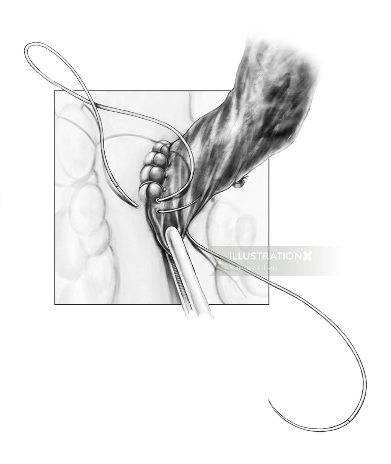 Ilustração do procedimento de cirurgia de revascularização do miocárdio por Shelley Li Wen Chen