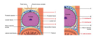 Ilustración de prostatectomía radical con conservación de nervios por Shelley Li Wen Chen
