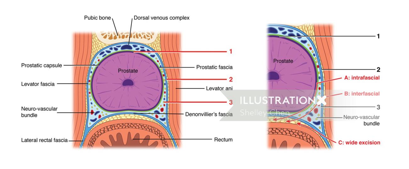 Ilustração de prostatectomia radical poupadora de nervos por Shelley Li Wen Chen