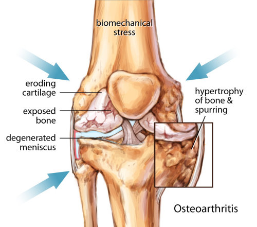 Ilustración de la articulación de la rodilla de la osteoartritis por Shelley Li Wen Chen