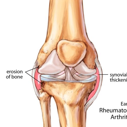 Early rheumatoid arthritic knee joint illustration by Shelley Li Wen Chen