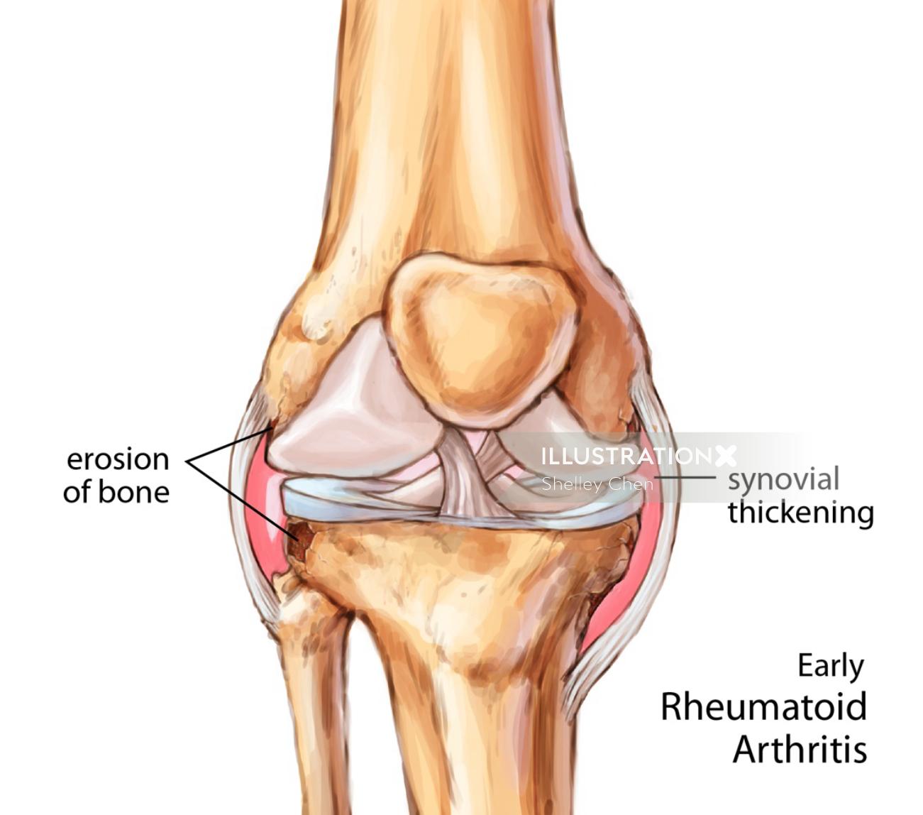 Ilustração inicial da articulação artrítica reumatóide do joelho por Shelley Li Wen Chen
