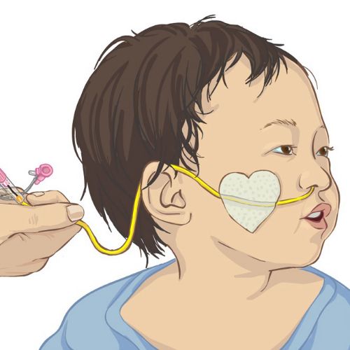 NG Tube Taping in Infants illustration by Shelley Li Wen Chen