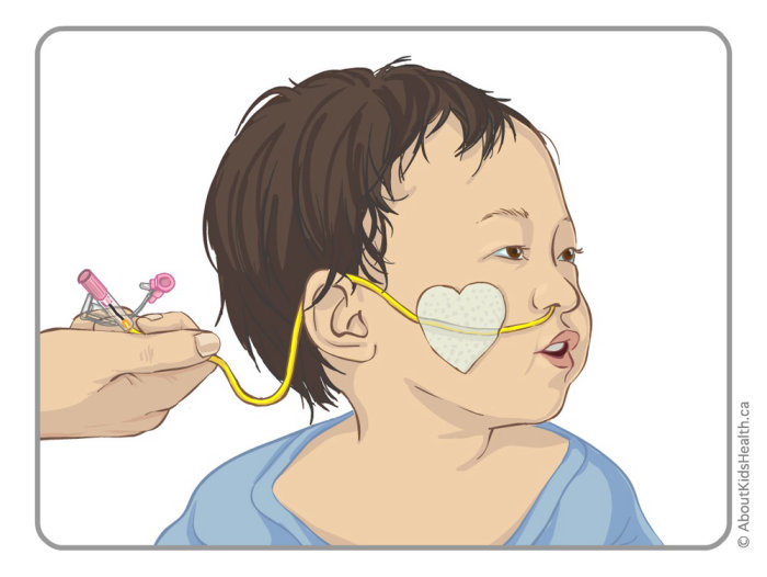 Shelley Li WenChenによる乳児のNGチューブテーピングのイラスト