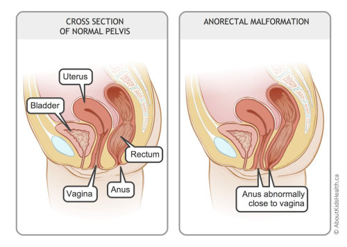 Girl anorectal malformations illustration by Shelley Li Wen Chen