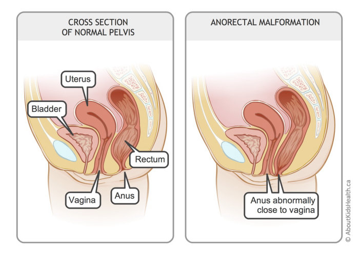 Girl anorectal malformations illustration by Shelley Li Wen Chen