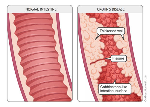 Ilustración de la enfermedad de Crohn por Shelley Li Wen Chen
