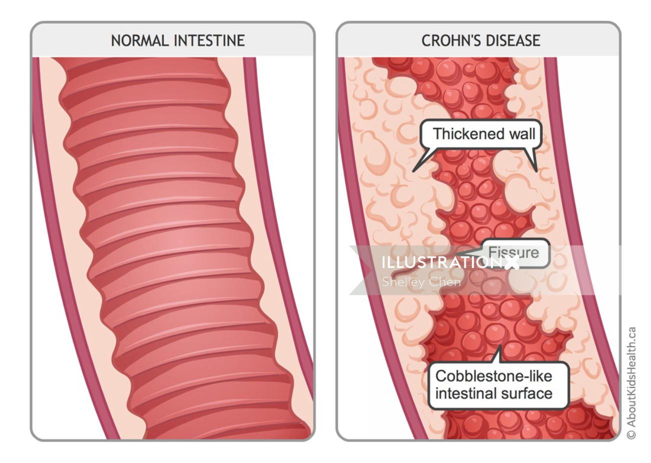 Ilustração da doença de Crohn por Shelley Li Wen Chen