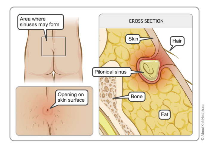 Pilonidal cyst illustration by Shelley Li Wen Chen