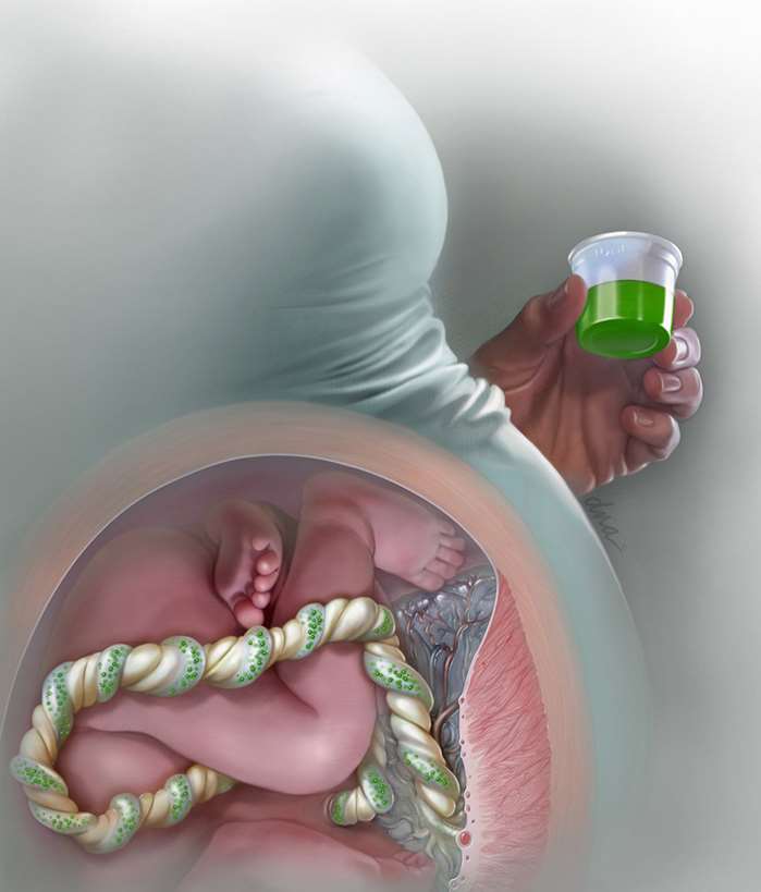 Medical artwork showing the use of methadone in pregnancy