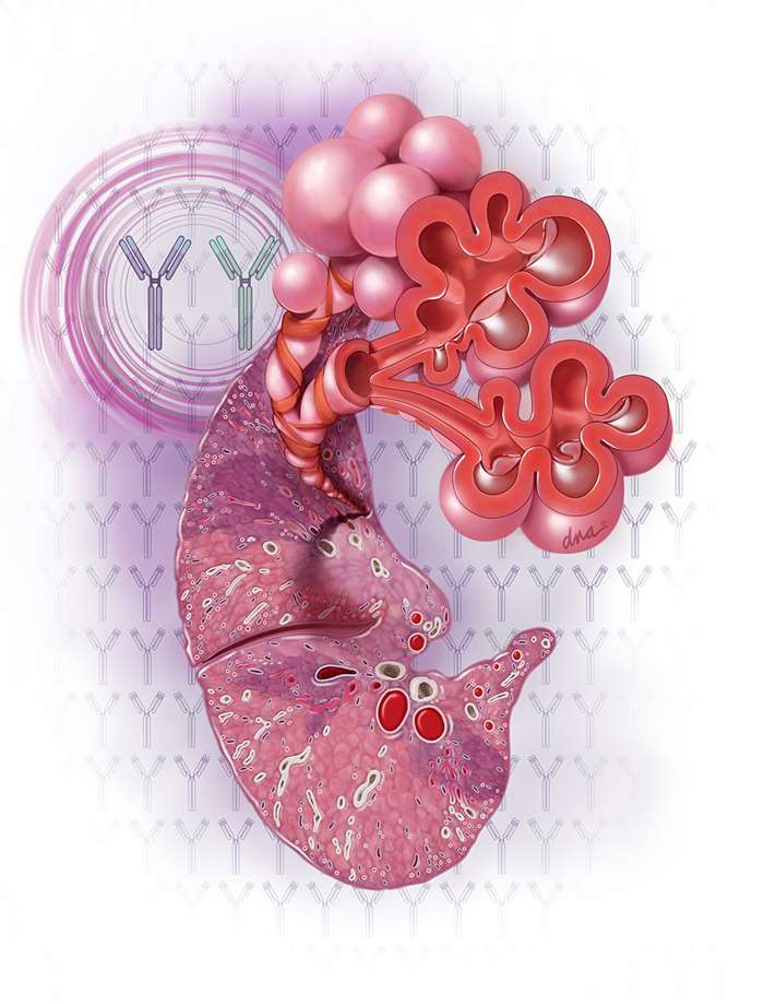 Medical Illustration of Lung Inflammation