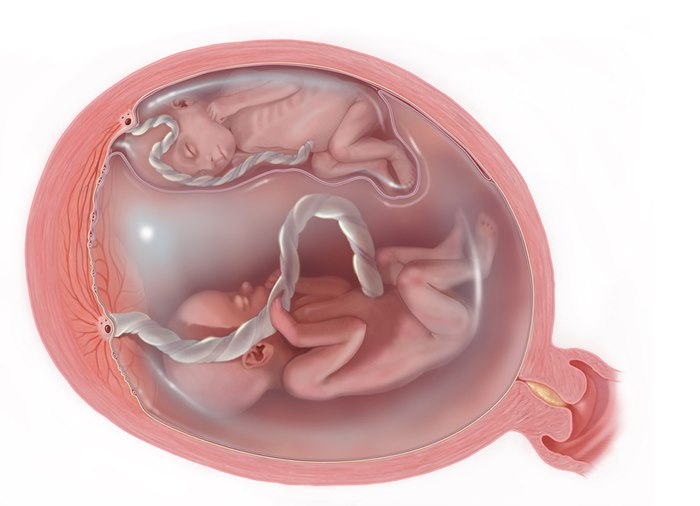 Medical illustration of Twin-Twin Transfusion Syndrome