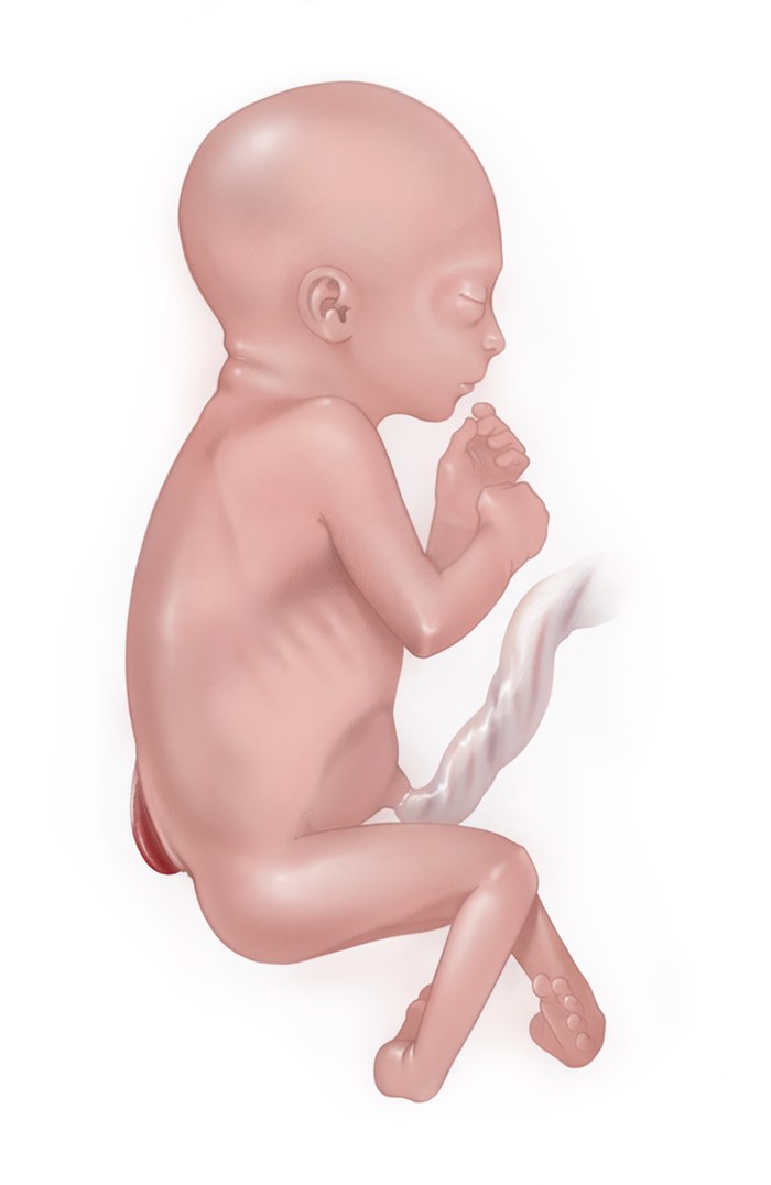Photorealistic illustration of a baby with Myelomeningocele