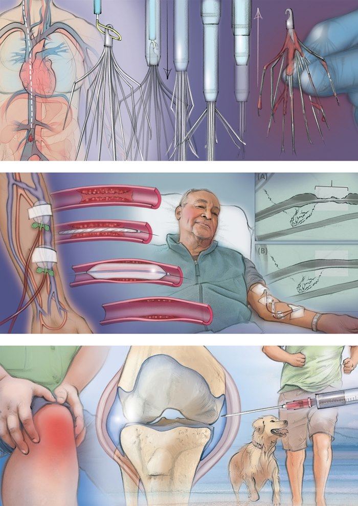 Realistic illustration of kidney tumour ablations