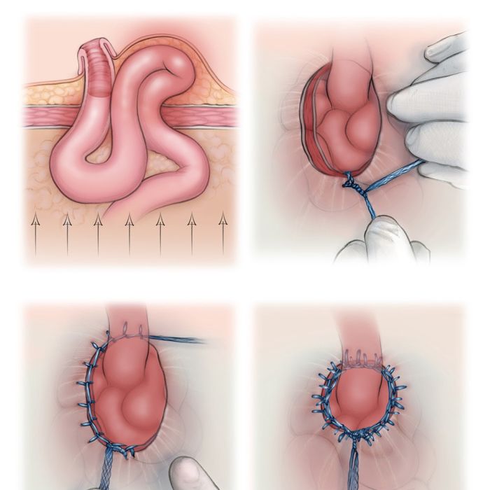 Turning Surgery into Storytelling